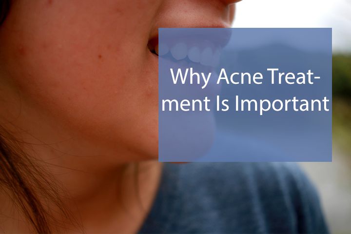 Why Acne Treatment Is Important